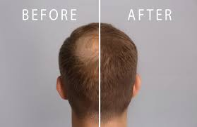 HOW TO INCORPORATE HAIR LOSS TREATMENT PRODUCTS INTO YOUR PROFESSIONAL SERVICE MENU